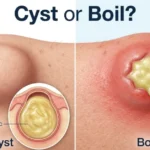 Cyst or Boil